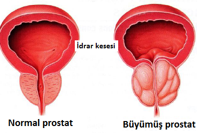 iyi huylu prostat büyümesi